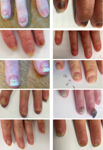 Ridges In Fingernails After Chemo - Awesome Nail