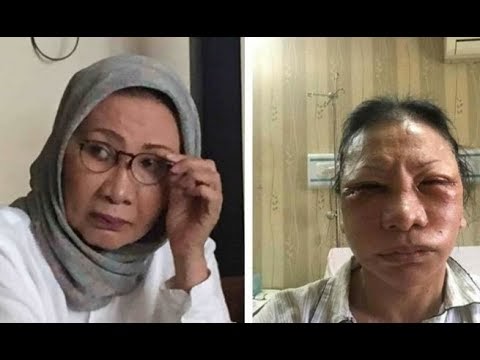 Concept Lebam Oplas dan Dusta Ratna Sarumpaet 2 Video Concept Lebam Oplas dan Dusta Ratna Sarumpaet 2 Video