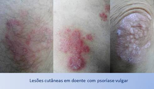 Psoriasis treatment often involves creams and ointments. Psoriase Metis