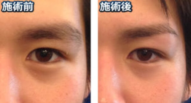 Ngantuoisoneo5 壮大 まつ毛 カット 男