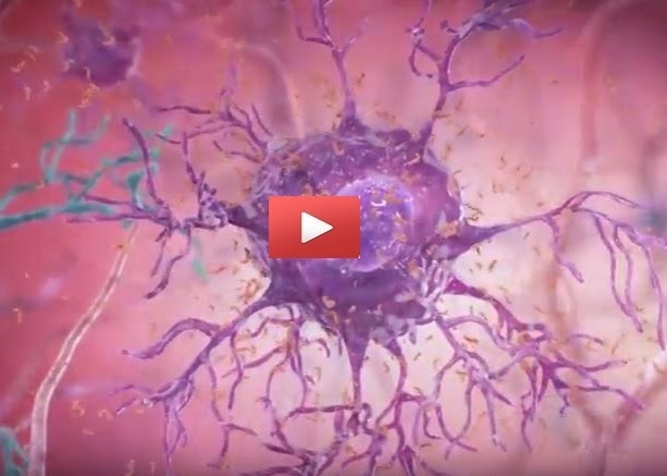 Screenshot of Alzheimer's video. Follow link for full full video