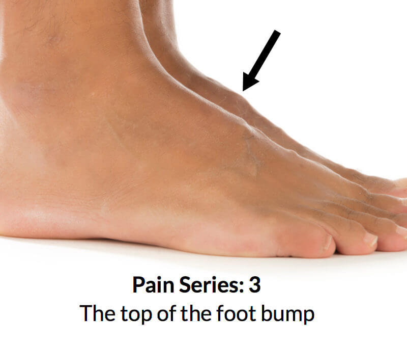 The #1 cause of bone spurs on top of the foot is almost always due to bone arthritis, foot. Foot Bump On Top Of The Foot Consulting Footpain