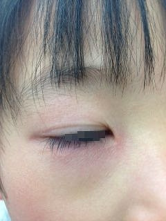 ぜいたく子供 目の周り 赤い ポツポツ かわいい子供たちの画像