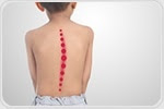 Study links scoliosis to essential dietary mineral