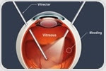 What is a Vitrectomy?