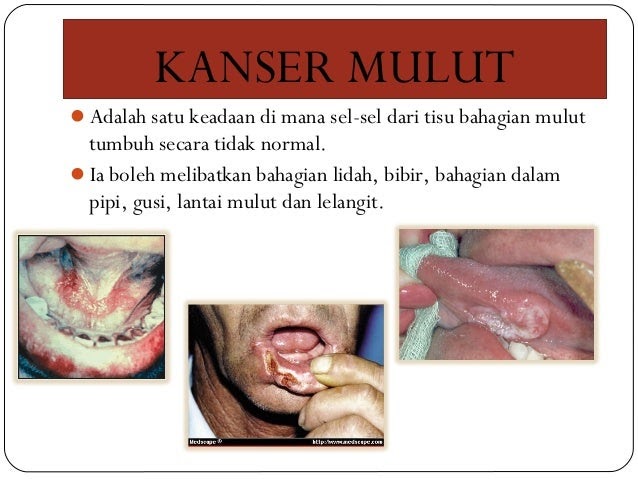 Cara Ubat Sakit Gusi - Rawatan 2