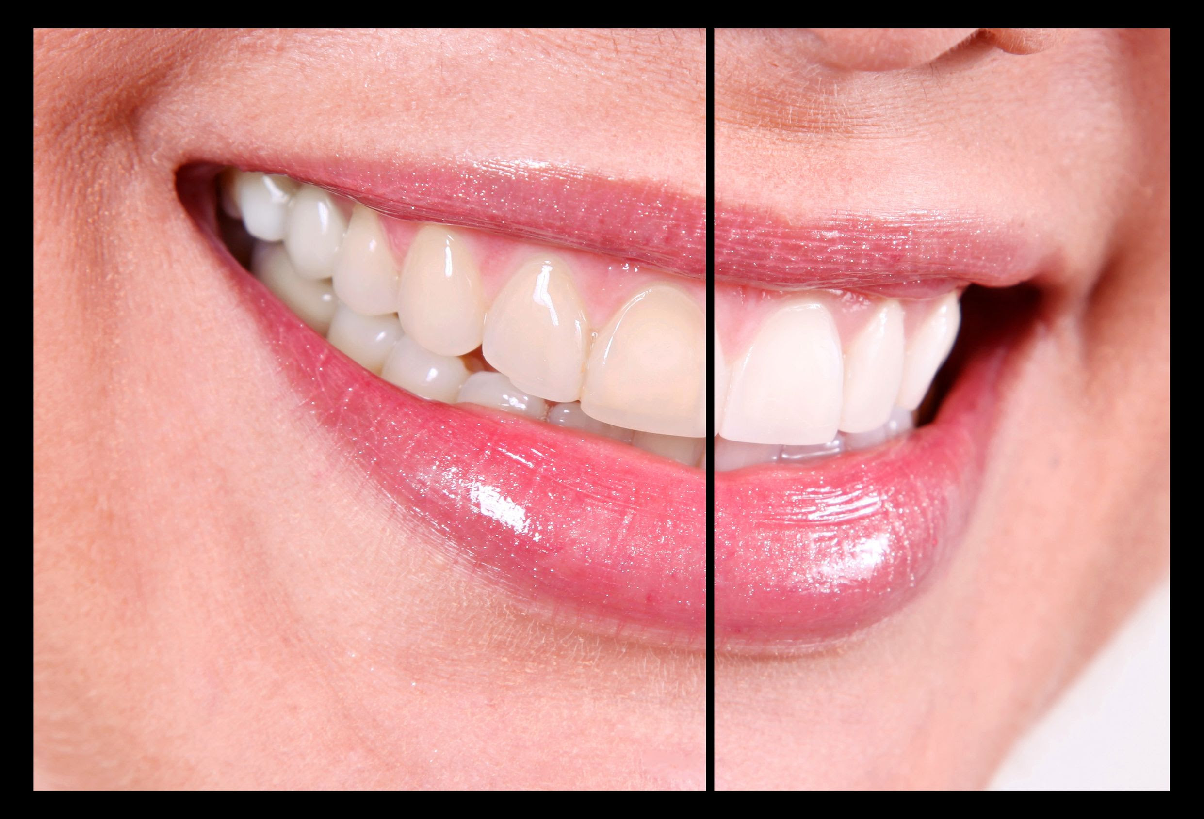 Best Teeth Whitening In Office