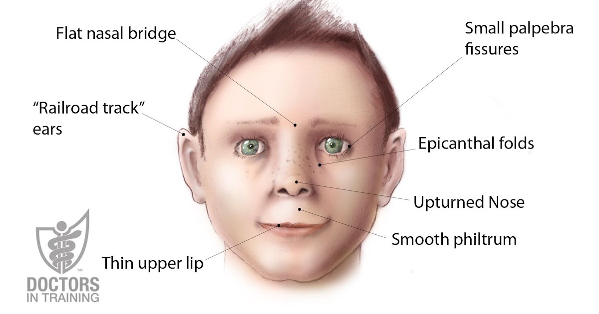 Flat Nasal Bridge And Epicanthal Folds - Pseudoesotropia ...