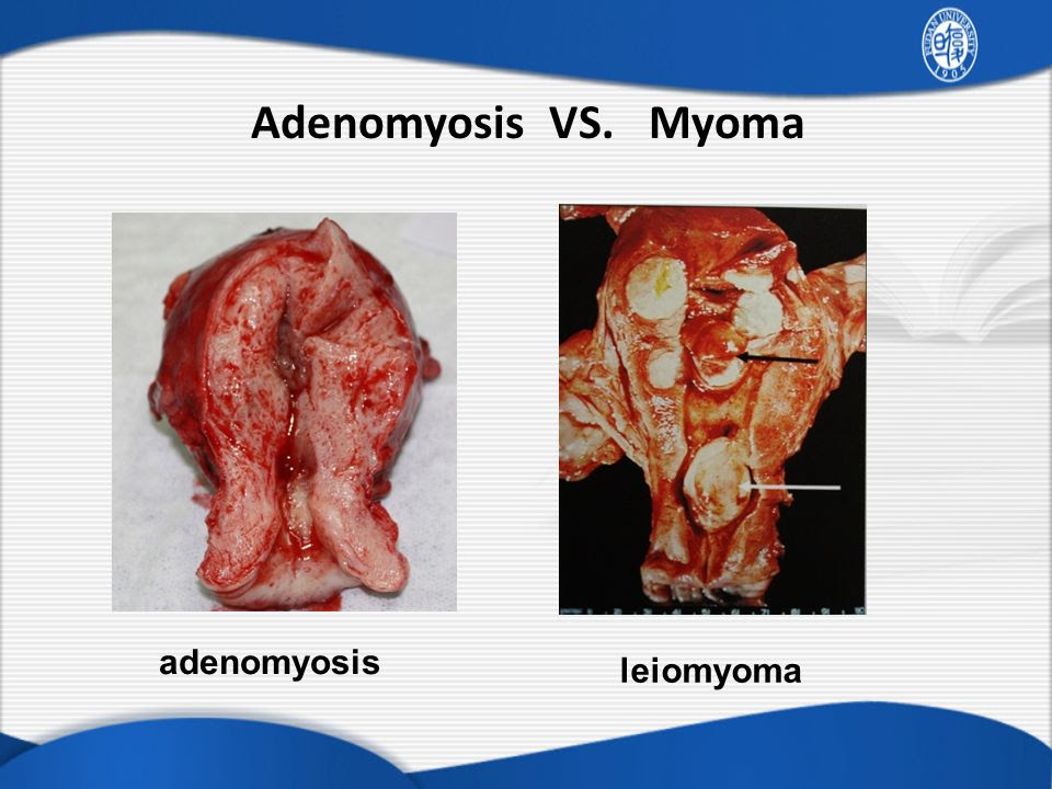 Endometrial Cancer Illustration