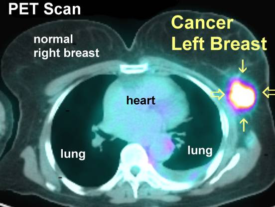 The pet scanner detects signals from the tracer. Pet Scans In Cancer Cases