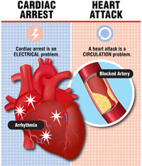 On 24th february, sridevi, the most beloved bollywood star and a veteran actress passed away it is not uncommon for people with minimal medical knowledge to get confused between a cardiac arrest and a heart attack. Understanding The Difference Between Heart Attack And Cardiac Arrest Cardiac Wellness Institute