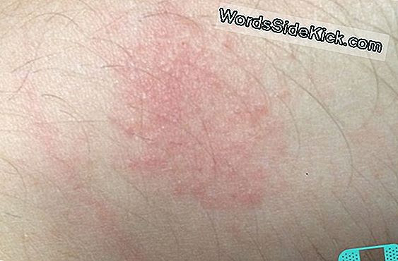 Inflammationen i huden ger sårbildning och cirka två tredjedelar av de som drabbas får ärr eller förändringar i hudens pigmentering. Lyme Disease Symptom Och Behandling 2021 Halsa