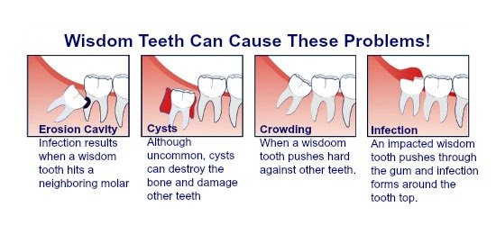 Are Your Ready For Wisdom Teeth Removal