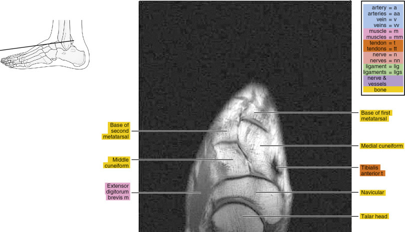 Chronic tear often manifests as thickening, thinning, elongation, and wavy or irregular contour of the ligament. Mri Of The Foot Radiology Key