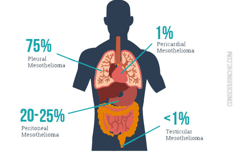 Diseases that attack these organs can cause serious health problems, so the sooner you know about them,. In The Know Mesothelioma Cancer Causes Conscious Chic
