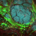 Breast Tumor Microenvironment