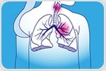 Aggressive local therapy for stage IV lung cancer patients improves progression-free survival