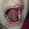 Pickel Auf Der Zunge - Schwarze Haarzunge Nebenwirkung Von Antibiotika Der Spiegel - Die meisten pickel auf der zunge erscheinen ohne ersichtlichen grund und gehen von selbst weg.