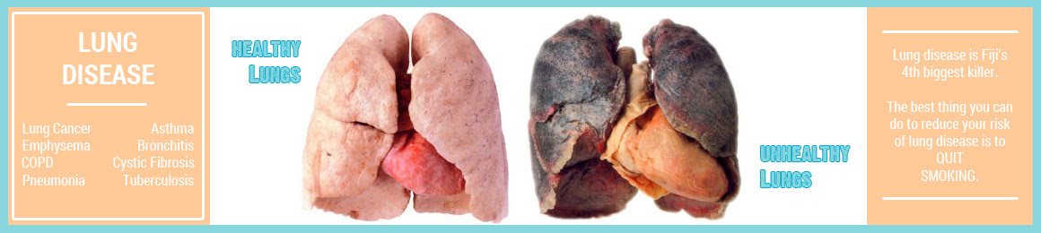Asbestos Disease Of The Lungs