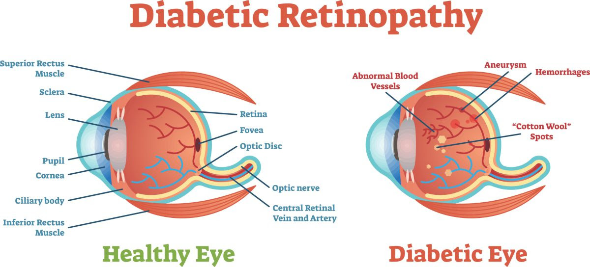 San fernando city hall finance counter 117 macneil street san fernando, ca 91340. Diabetic Retinopathy Eye Care In Northridge Chatsworth