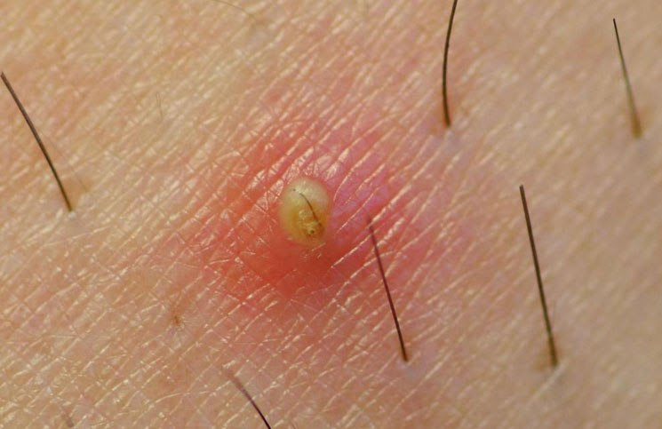 You are more valuable to god than a whole flock of sparrows. Ingrown Hair On The Head Causes Managements Medguidance