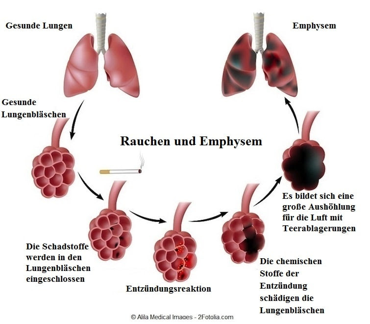 Copd Krankheit Symptome - Hirup j
