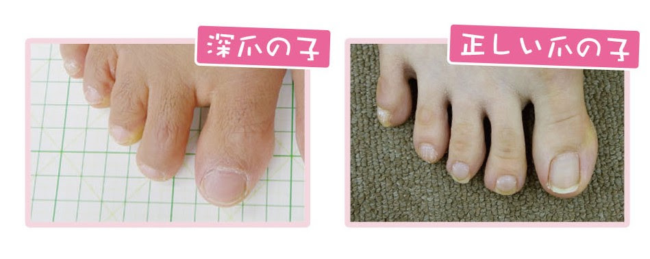 イメージカタログ 最高 赤ちゃん 足の爪 割れる