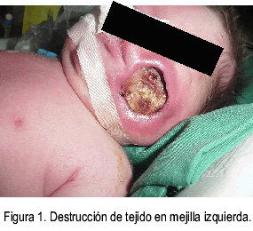 Es una infección micótica (hongos) de los senos paranasales, el cerebro o los pulmones. Mucormicosis Cutanea En Un Recien Nacido Pretermino A Proposito De Un Caso