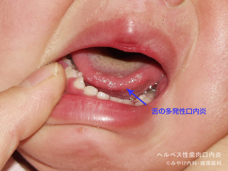 ヘルペス性口内炎 大人 治療