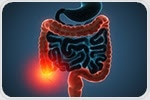 Steven R. Brant shines light on genetic causes for IBD