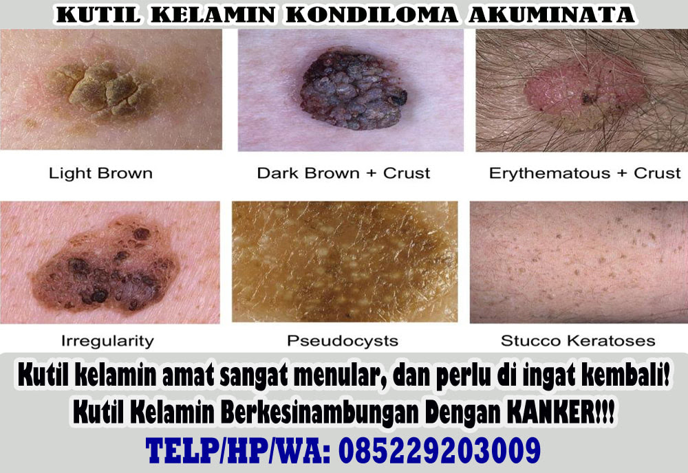 Ubat Ketuat Terbaik - Contoh Ert