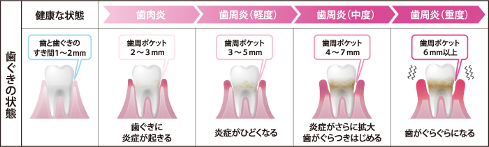 美しい花の画像 ロイヤリティフリー歯肉炎 イラスト