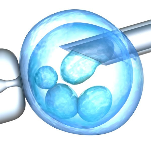 Assisted reproduction analysis. IVF children adverse side effects has been confirmed with more medical problems than children conceived naturally