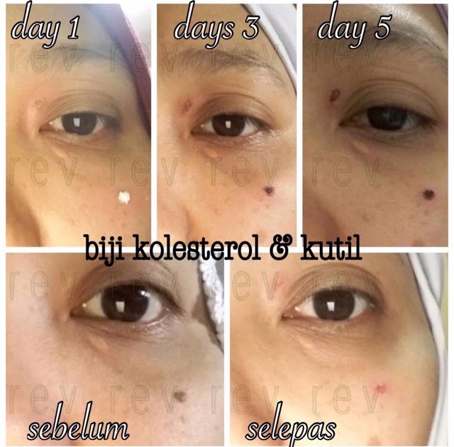 cara hilangkan biji kolesterol