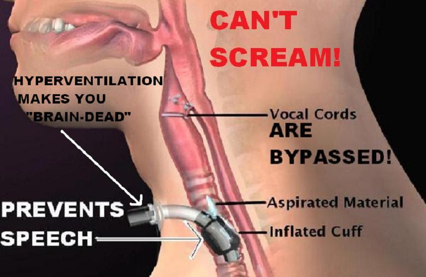 Copd Patient Undergoing Surgery - Hirup x