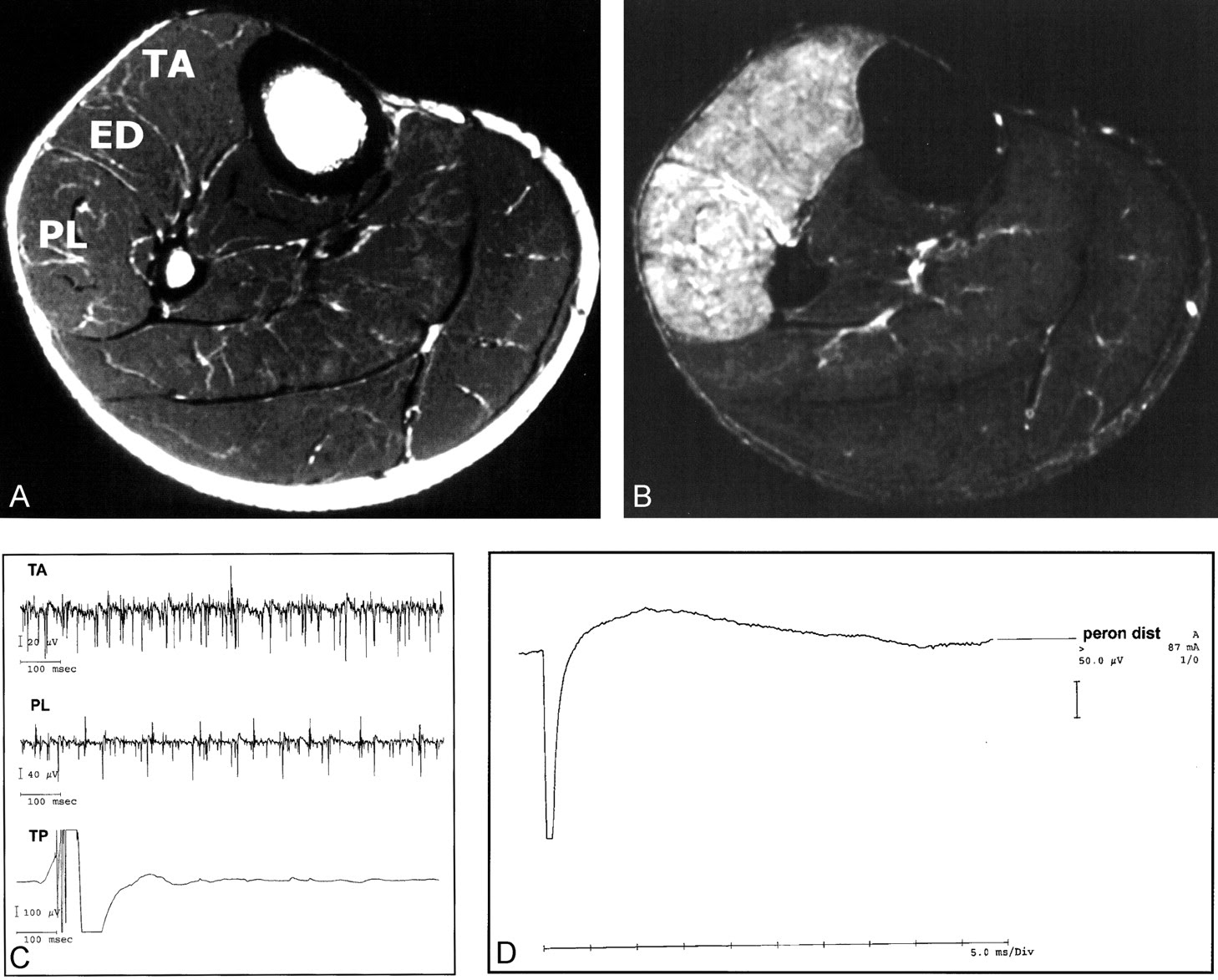 Dislocation of the peroneal tendons is often clinically misdiagnosed as an ankle sprain. Mr Imaging In The Differential Diagnosis Of Neurogenic Foot Drop American Journal Of Neuroradiology