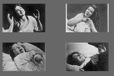 Today, epilepsy has a set of diagnostic criteria backed by the technology of electroencephalograms, yet hysteria has only a generic and vague profile. Jm Charcot Photos