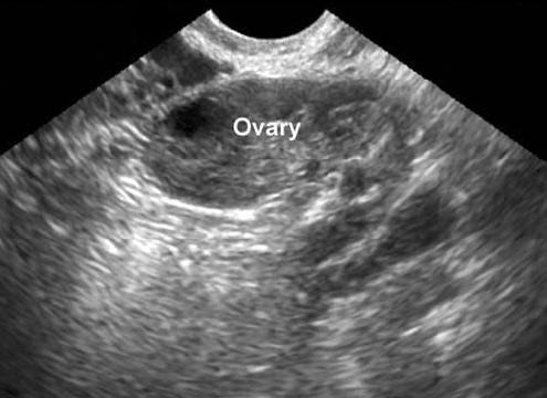 Ovarian, fallopian tube, and primary peritoneal cancer screening. sidney kimmel comprehensive cancer center at johns hopkins: Diagnosis For Ovarian Cancer Ovarian Cancer