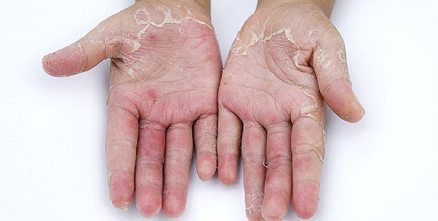 Skin irritation from lack of moisture, sunburn or an allergic reaction can also cause peeling on the hands and fingers. Home Remedy To Get Rid Of Hand Skin Peeling