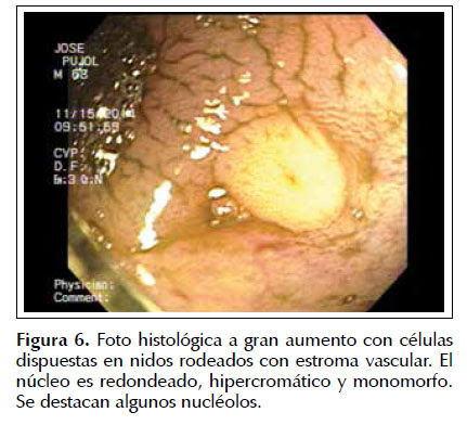 Other treatment options include somatostatin analogs, interferons, treatment of hepatic. Tumor Carcinoide A Proposito De Dos Casos Clinicos