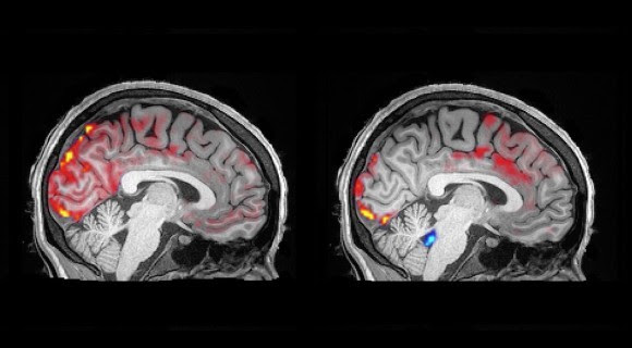 2 MRI images of the brain