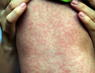 Measles cases on the rise in Europe