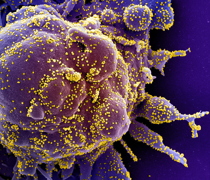 Colorized scanning electron micrograph of an apoptotic cell (purple) infected with SARS-COV-2 virus particles (yellow). Credit: NIAID