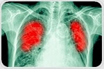 New combination approach may help crush resistance to treatment in lung cancer patients