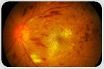 Novel approach could provide painless, efficient alternative for treating eye diseases