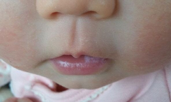 これまでで最高の唇 ぶつぶつ 白い 画像 美しい花の画像
