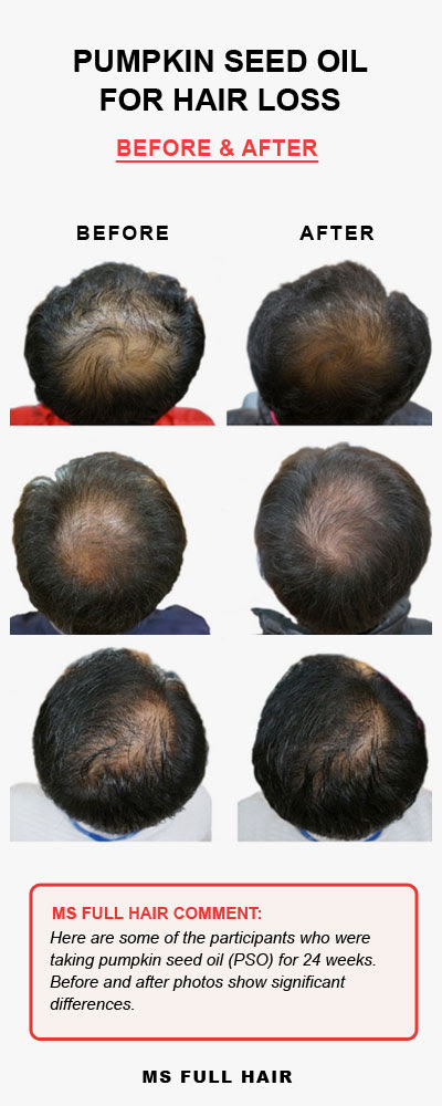Peppermint Oil Hair Growth Results | Blog Pendidikan Peppermint Oil Hair Growth Results | Blog Pendidikan
