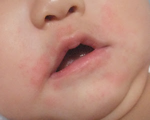 最高子供 口の周り 湿疹 かわいい子供たちの画像