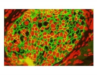 Epithelial to Mesenchymal Transition (EMT) in Neuroscience and Cancer