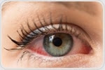Types of Eye Allergy